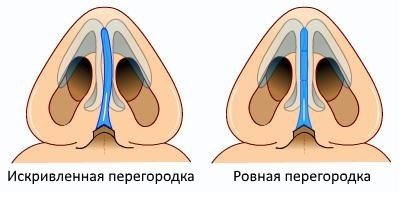 выравнивание носовой перегородки