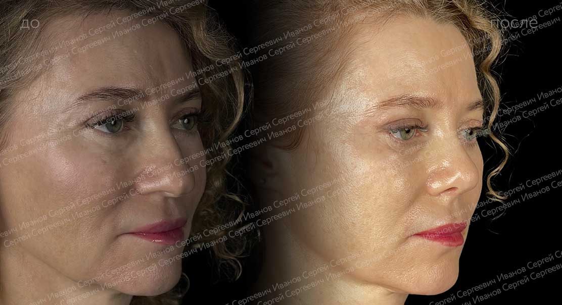 Открытая риносептопластика