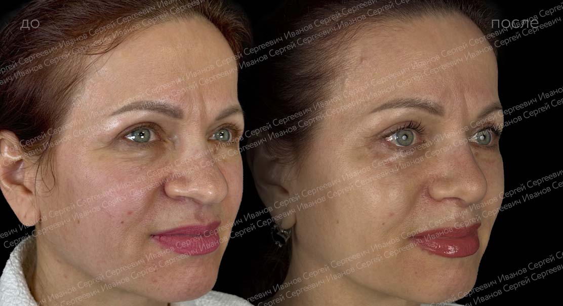 Риносептопластика