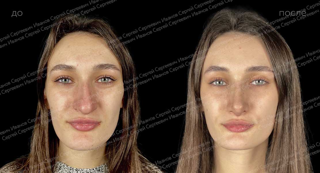Открытая риносептопластика