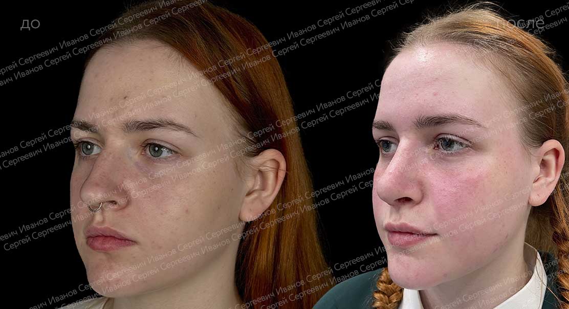Первичная риносептопластика